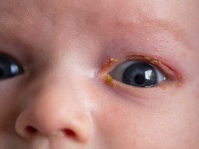 newborn eye infection treatment